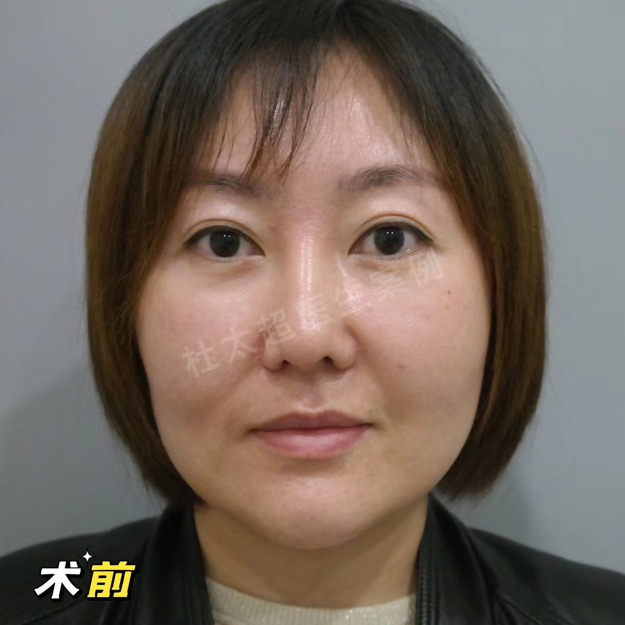 拉皮手术后能年轻多少岁？3个真人案例带你公布答案