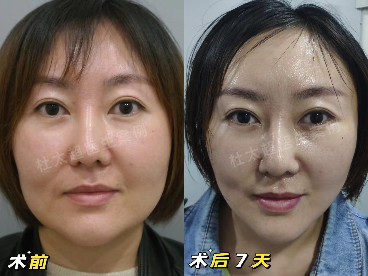 拉皮手术后能年轻多少岁？3个真人案例带你公布答案