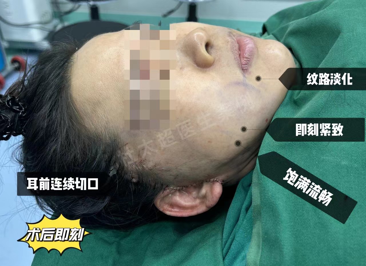 拉皮手术最好不要做,怕你接受不了崭新的自己! 以下为求美者自述: 拉皮手术最好不要做,怕你接受不了崭新的自己! 以下为求美者自述: