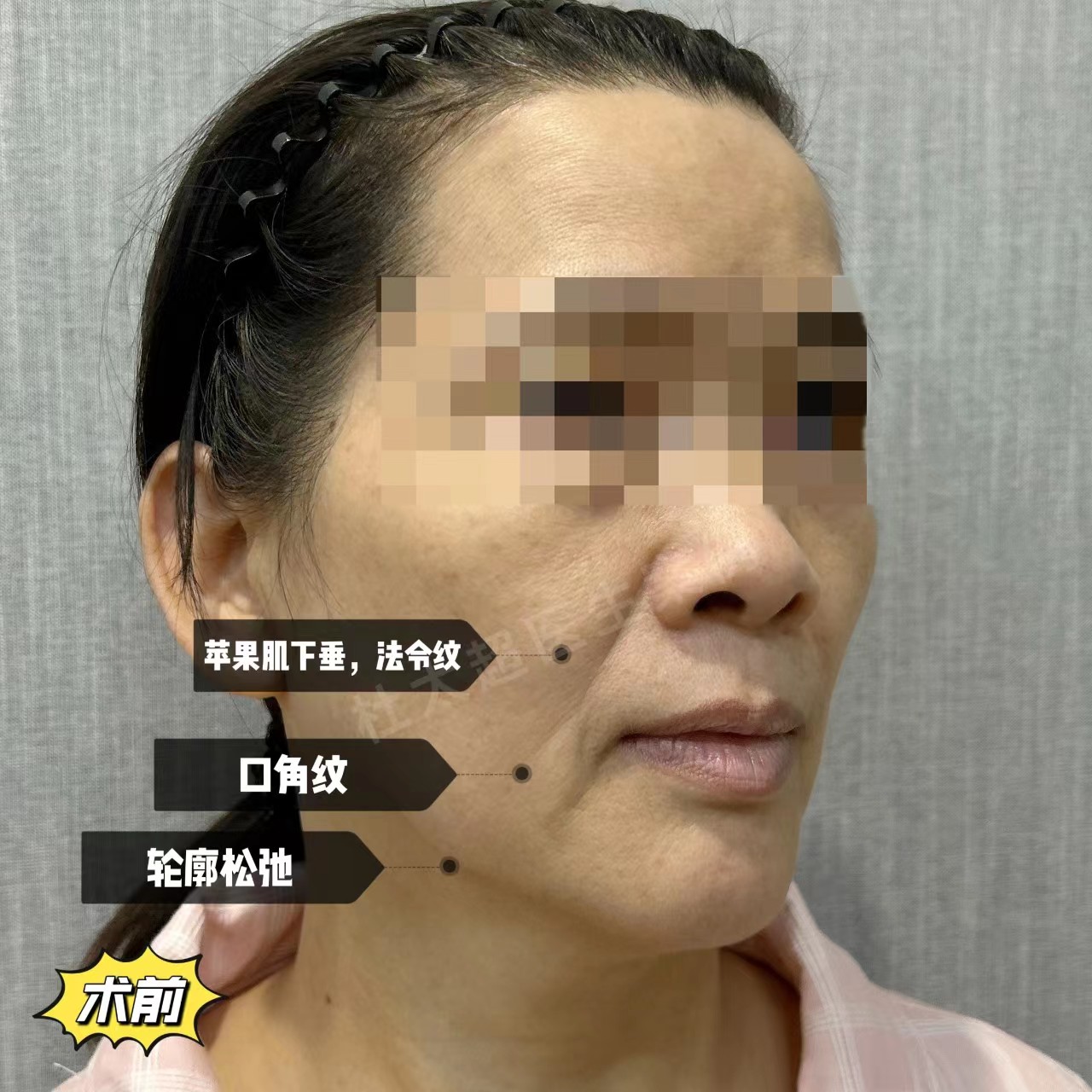 拉皮手术最好不要做,怕你接受不了崭新的自己! 以下为求美者自述: 拉皮手术最好不要做,怕你接受不了崭新的自己! 以下为求美者自述: