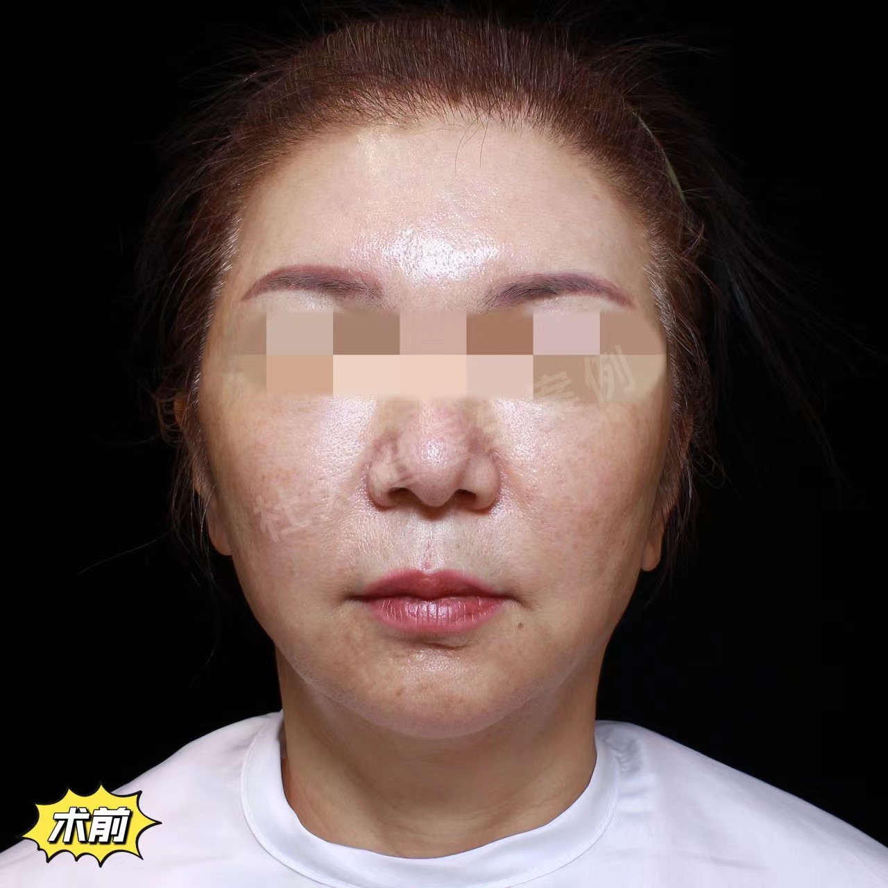 60岁到北京来做拉皮手术，术后2天秒变30+