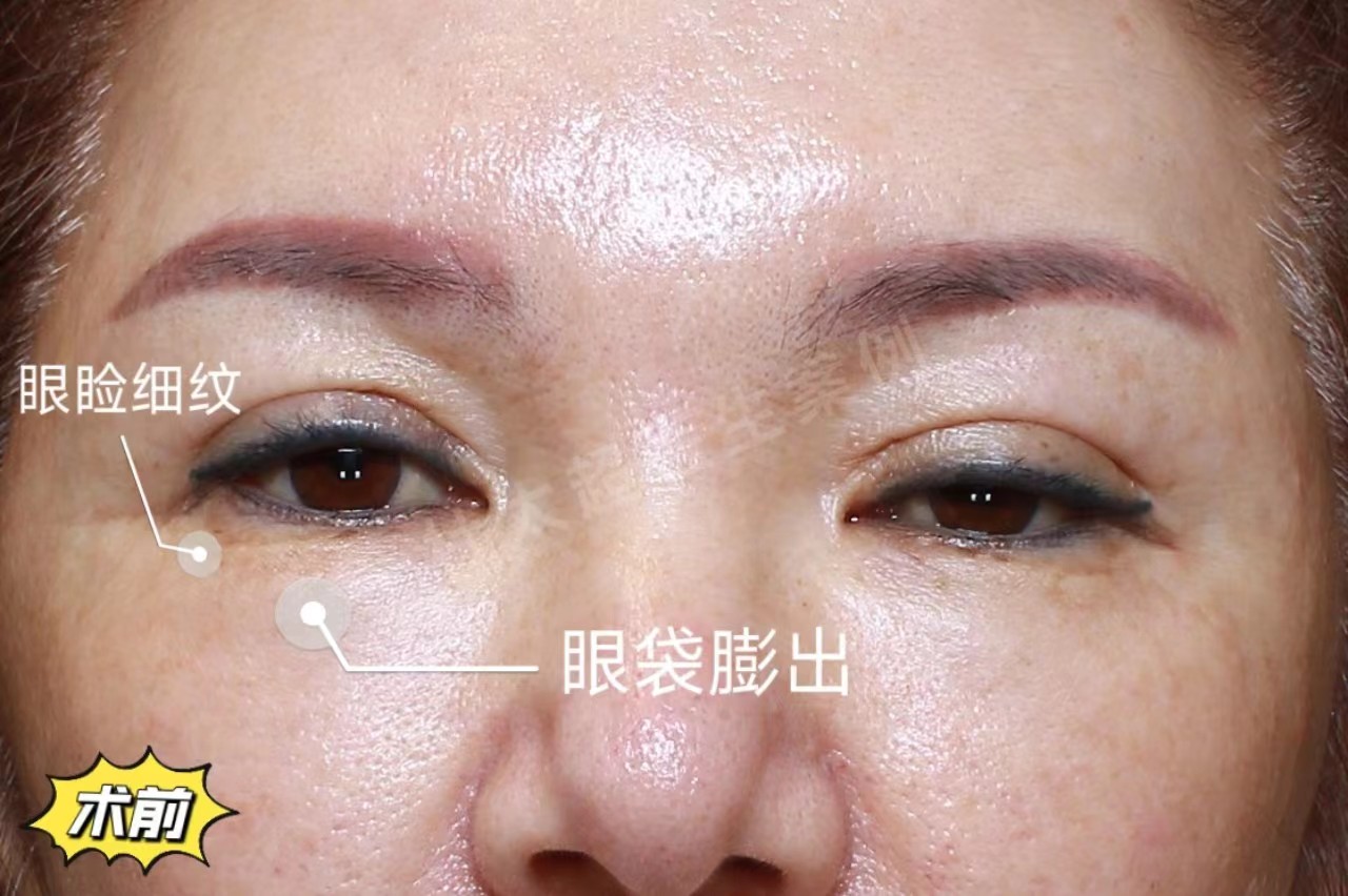 60岁到北京来做拉皮手术，术后2天秒变30+