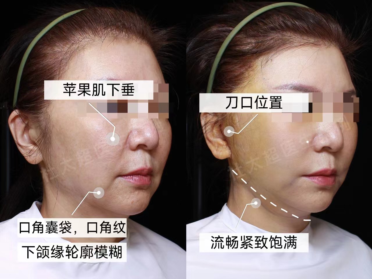 60岁到北京来做拉皮手术，术后2天秒变30+