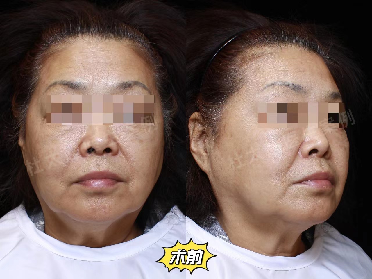 65岁做了吸脂+拉皮提升,发腮松弛一网打尽,效果好直接 65岁做了吸脂+拉皮提升,发腮松弛一网打尽,效果好直接