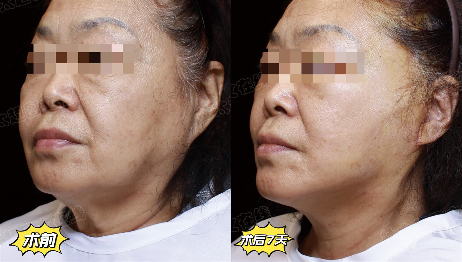 65岁做了吸脂+拉皮提升,发腮松弛一网打尽,效果好直接 65岁做了吸脂+拉皮提升,发腮松弛一网打尽,效果好直接