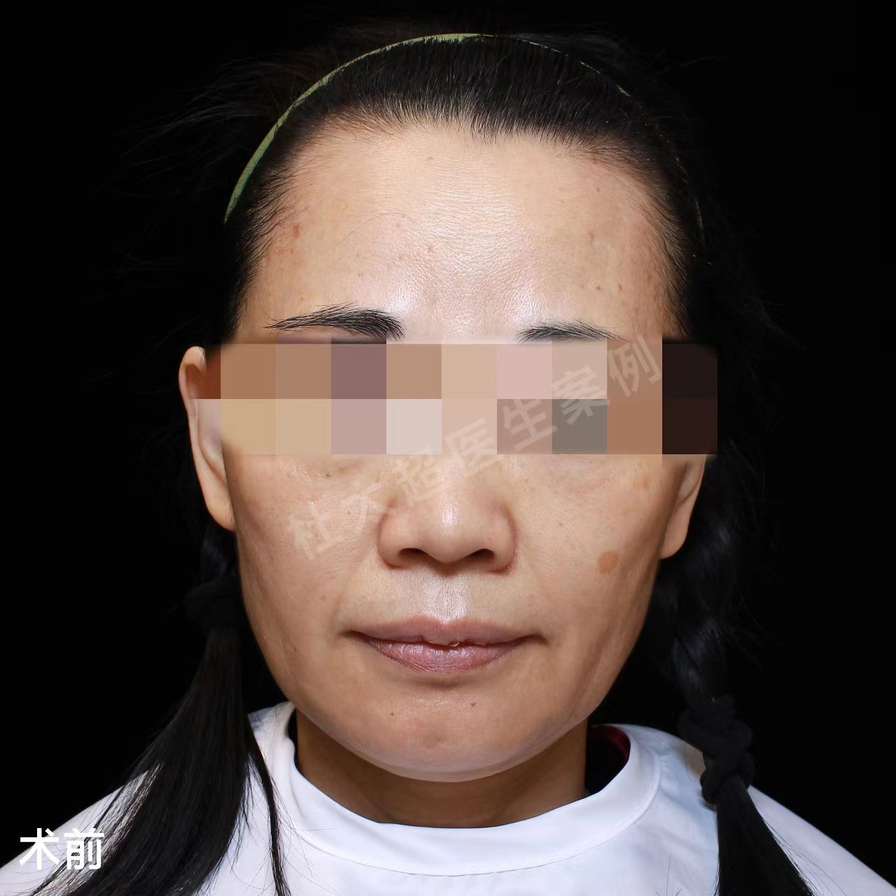 50岁从山东奔赴北京，多家对比做拉皮手术，术后年轻10多岁！