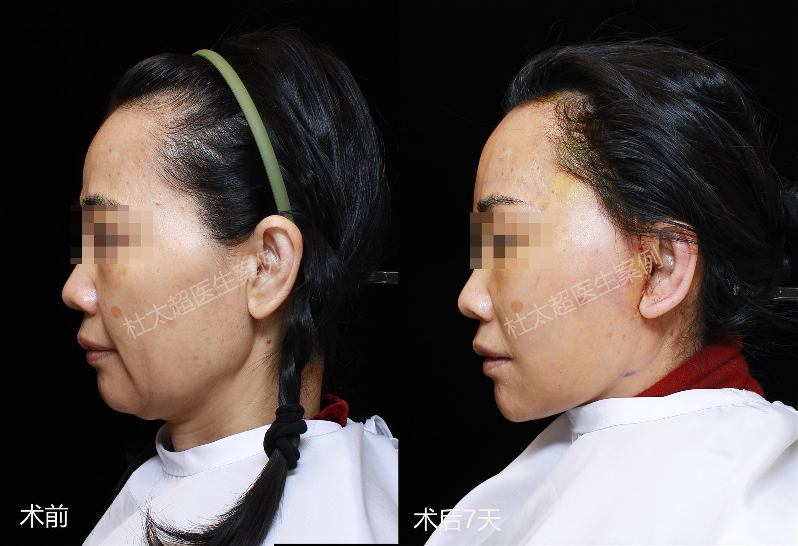 50岁从山东奔赴北京,多家对比做拉皮手术,术后年轻10多岁! 50岁从山东奔赴北京,多家对比做拉皮手术,术后年轻10多岁!