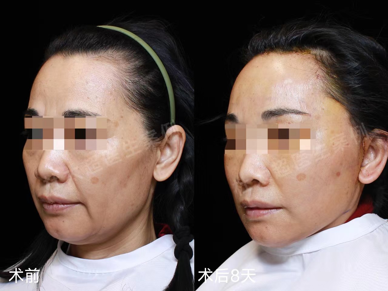 50岁从山东奔赴北京,多家对比做拉皮手术,术后年轻10多岁! 50岁从山东奔赴北京,多家对比做拉皮手术,术后年轻10多岁!