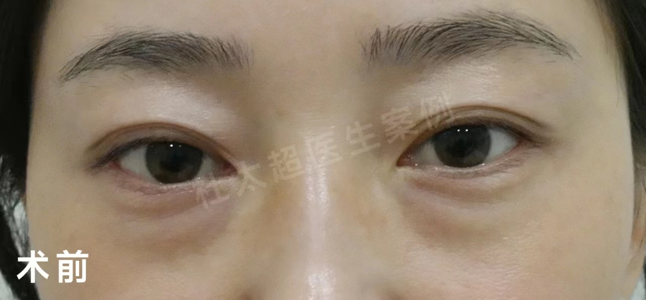 外切去眼袋+重睑修复案例分享,效果很明确! 外切去眼袋+重睑修复案例分享,效果很明确!
