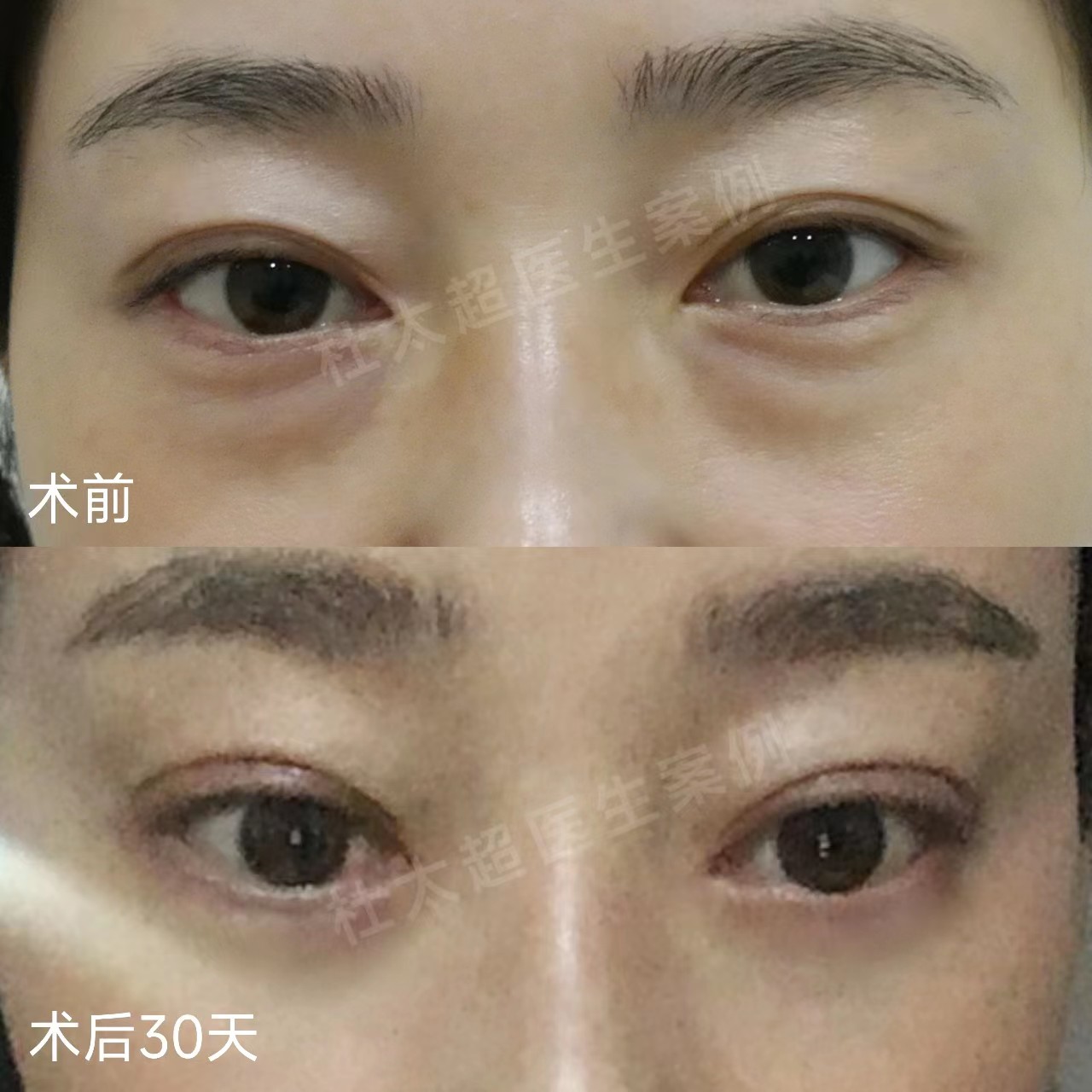 外切去眼袋+重睑修复案例分享,效果很明确! 外切去眼袋+重睑修复案例分享,效果很明确!