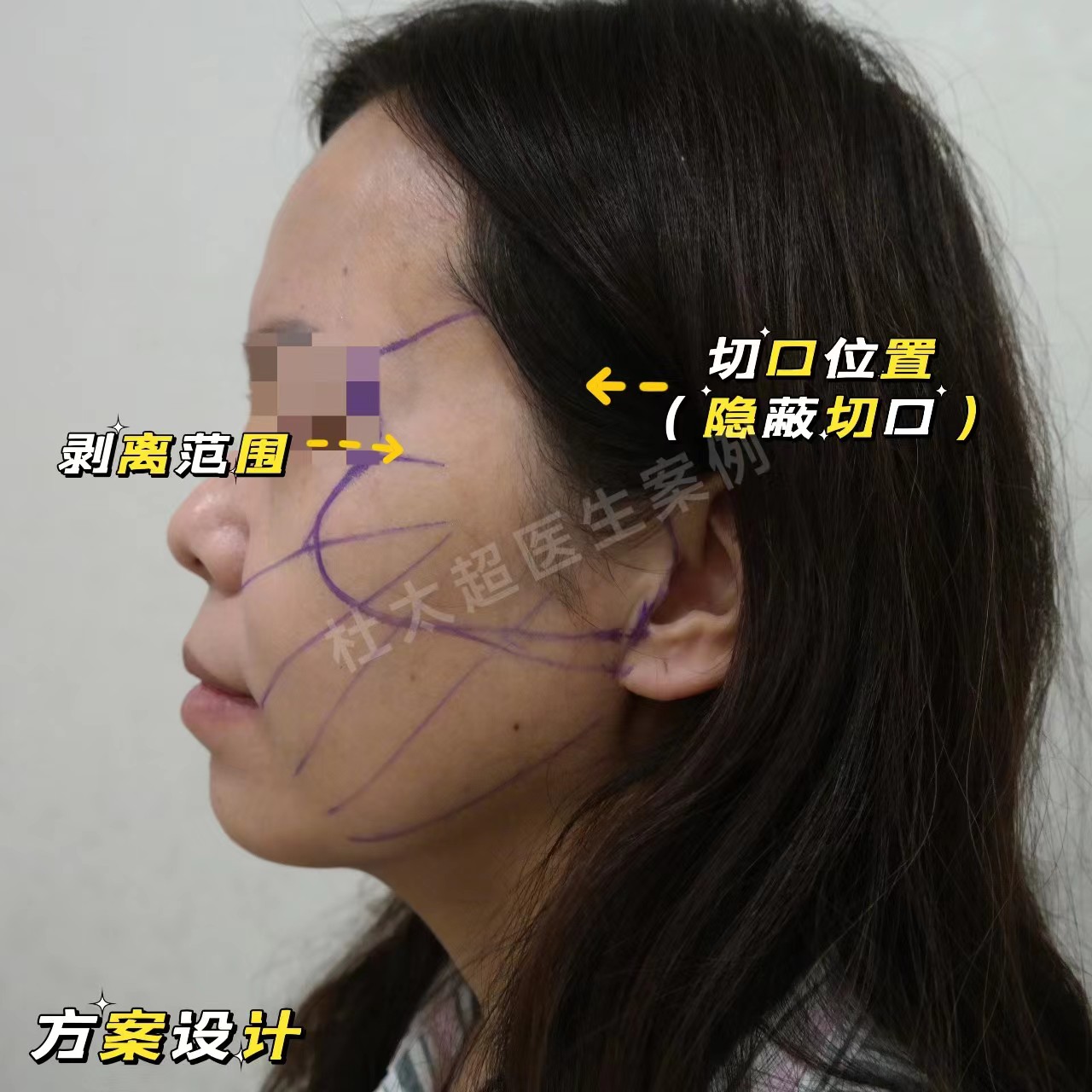 拉皮+去眼袋术后4年，状态比术前还要好
