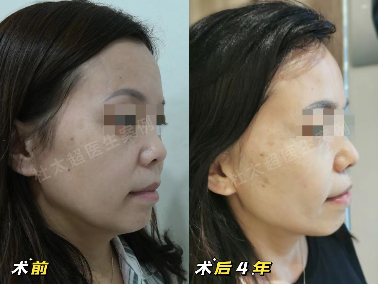 拉皮+去眼袋术后4年，状态比术前还要好