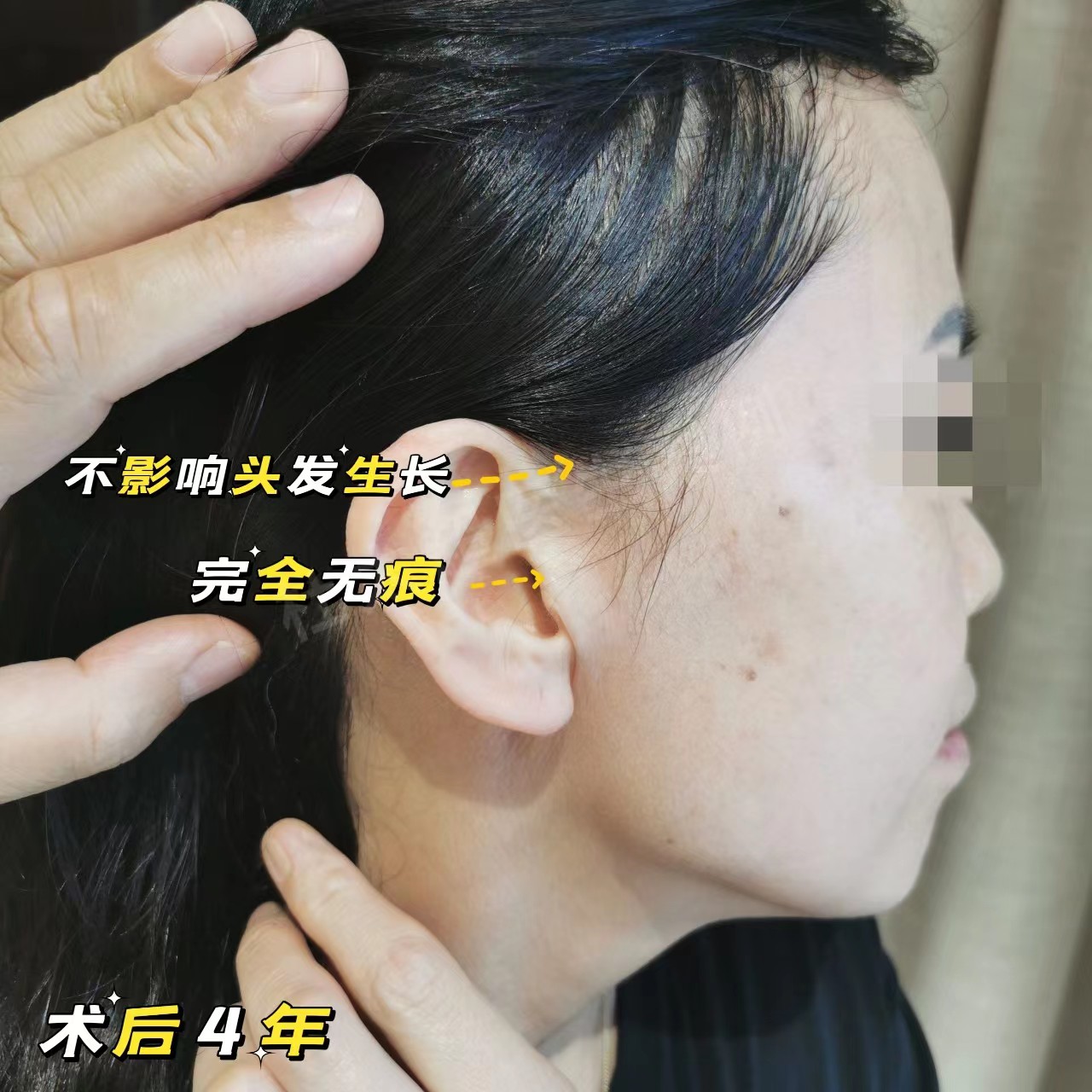 拉皮+去眼袋术后4年，状态比术前还要好