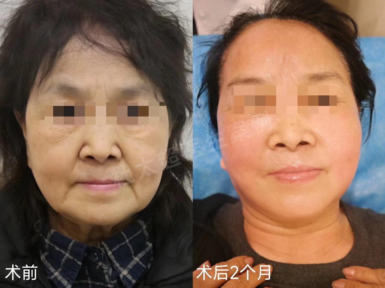 3个真人案例,带你感受,拉皮手术到底能年轻几岁? 3个真人案例,带你感受,拉皮手术到底能年轻几岁?