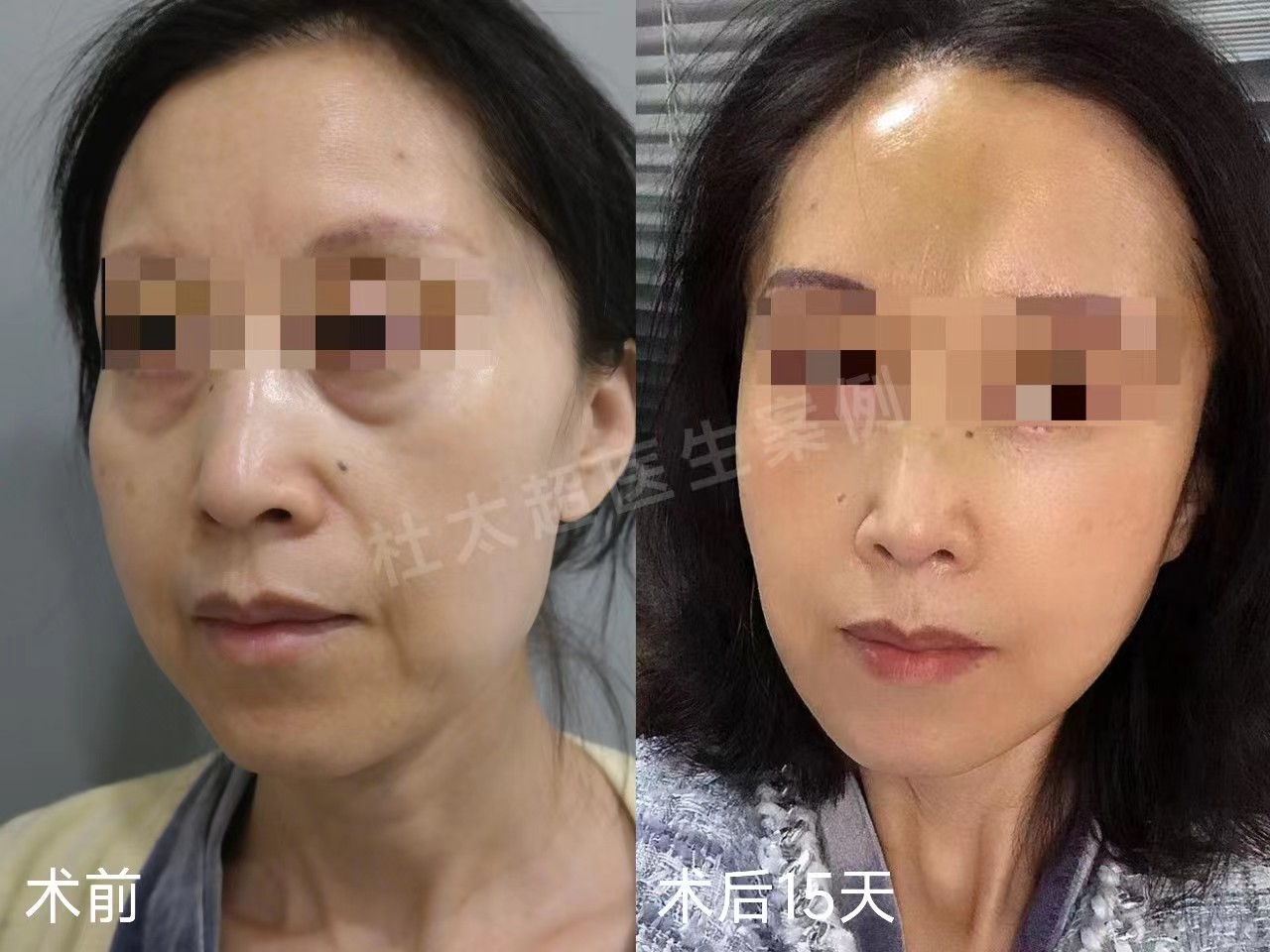 3个真人案例,带你感受,拉皮手术到底能年轻几岁? 3个真人案例,带你感受,拉皮手术到底能年轻几岁?