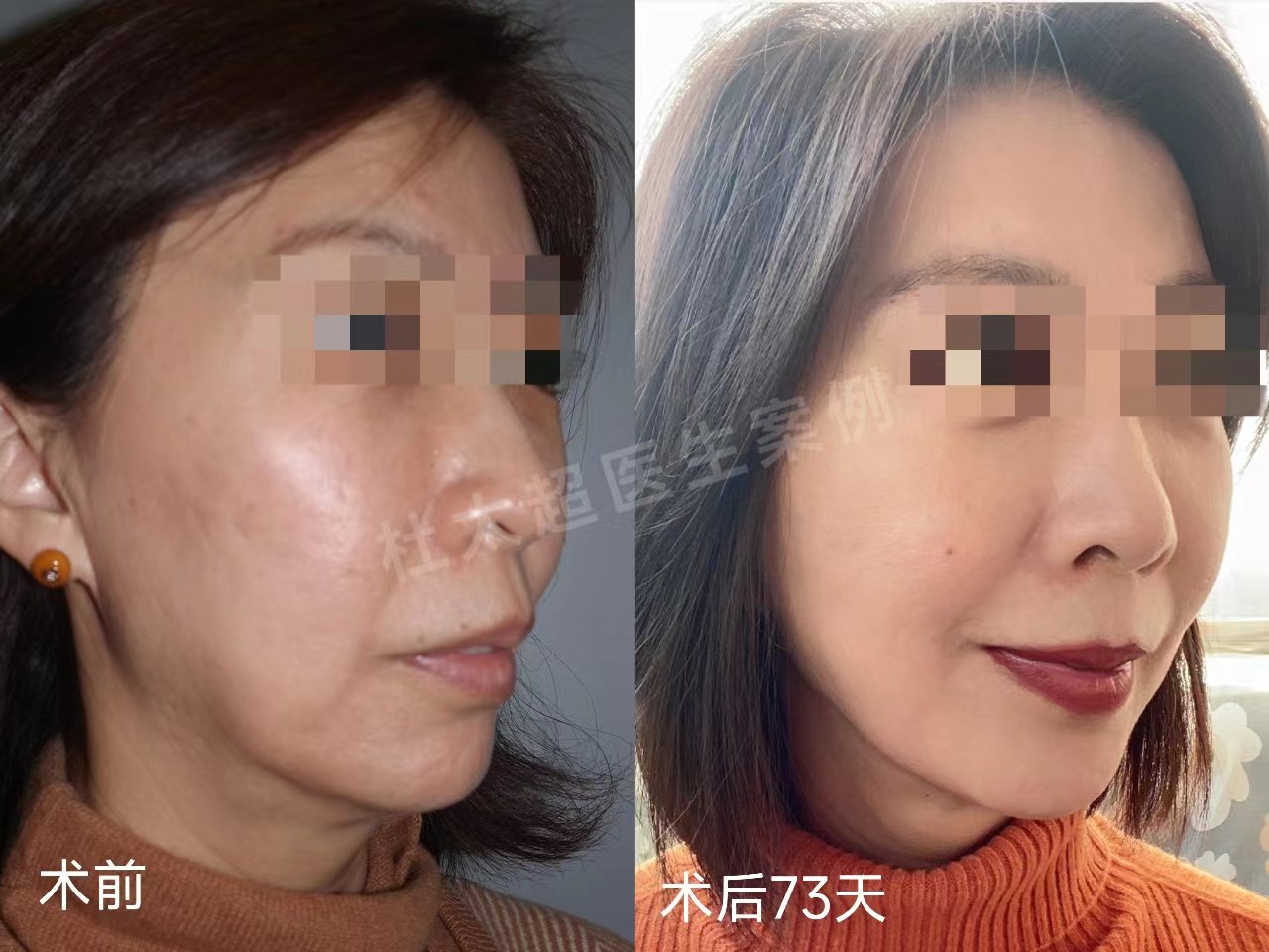 3个真人案例,带你感受,拉皮手术到底能年轻几岁? 3个真人案例,带你感受,拉皮手术到底能年轻几岁?