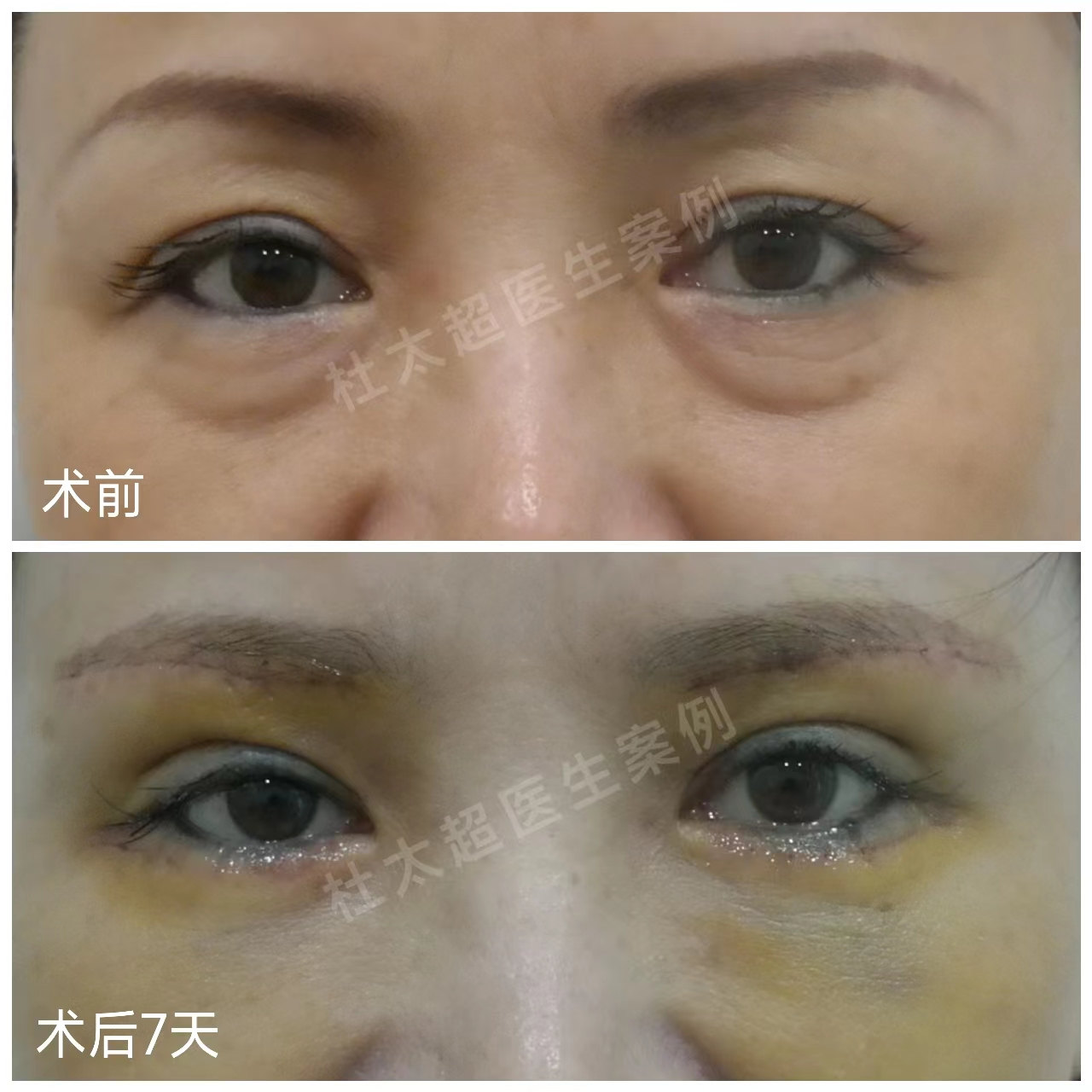 真人案例告诉你:眼周问题不要拖,找对方法不走“弯路”! 真人案例告诉你:眼周问题不要拖,找对方法不走“弯路”!