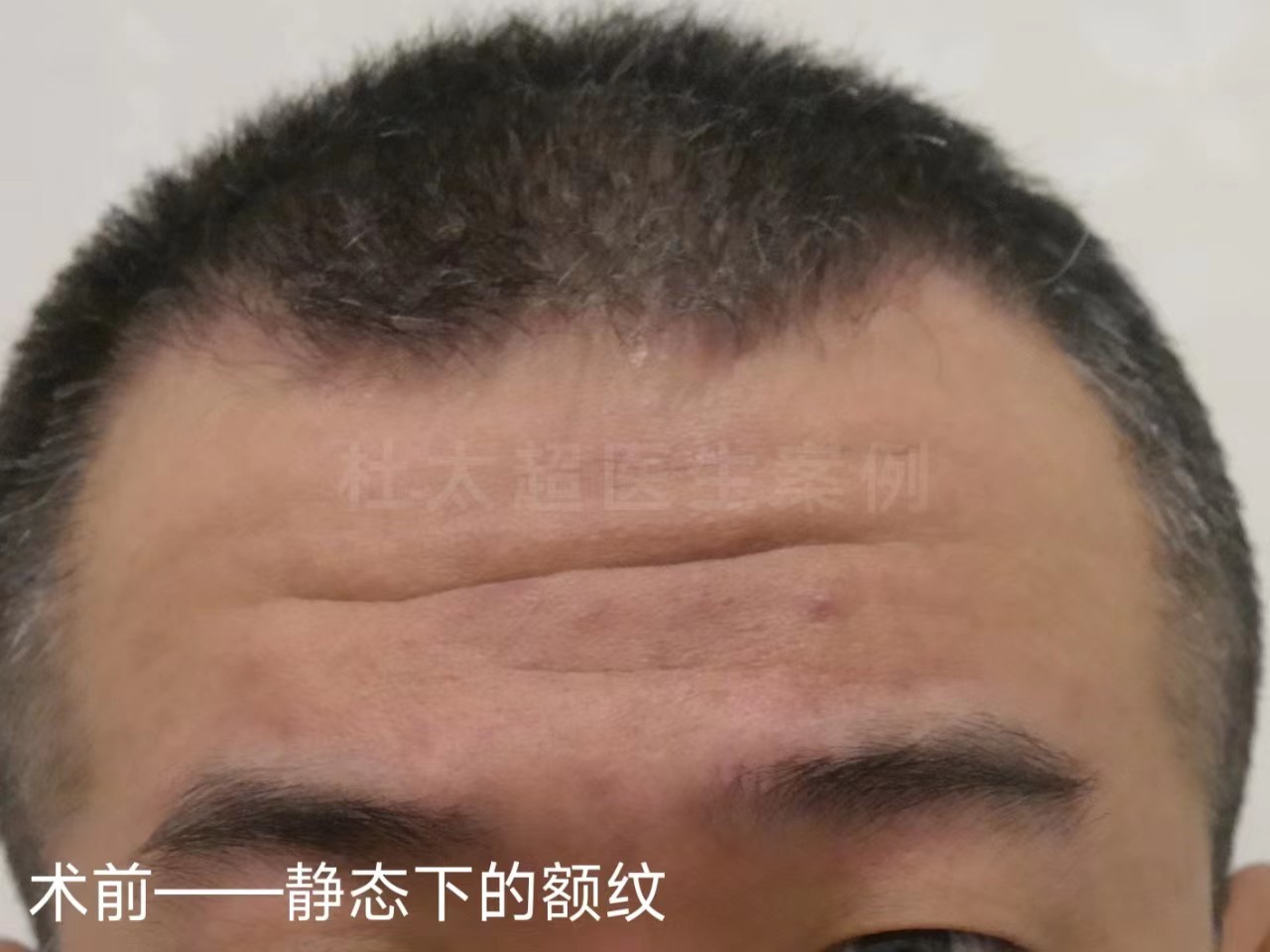 男士额纹深邃,不接受大切口除皱,这样做有效改善! 男士额纹深邃,不接受大切口除皱,这样做有效改善!