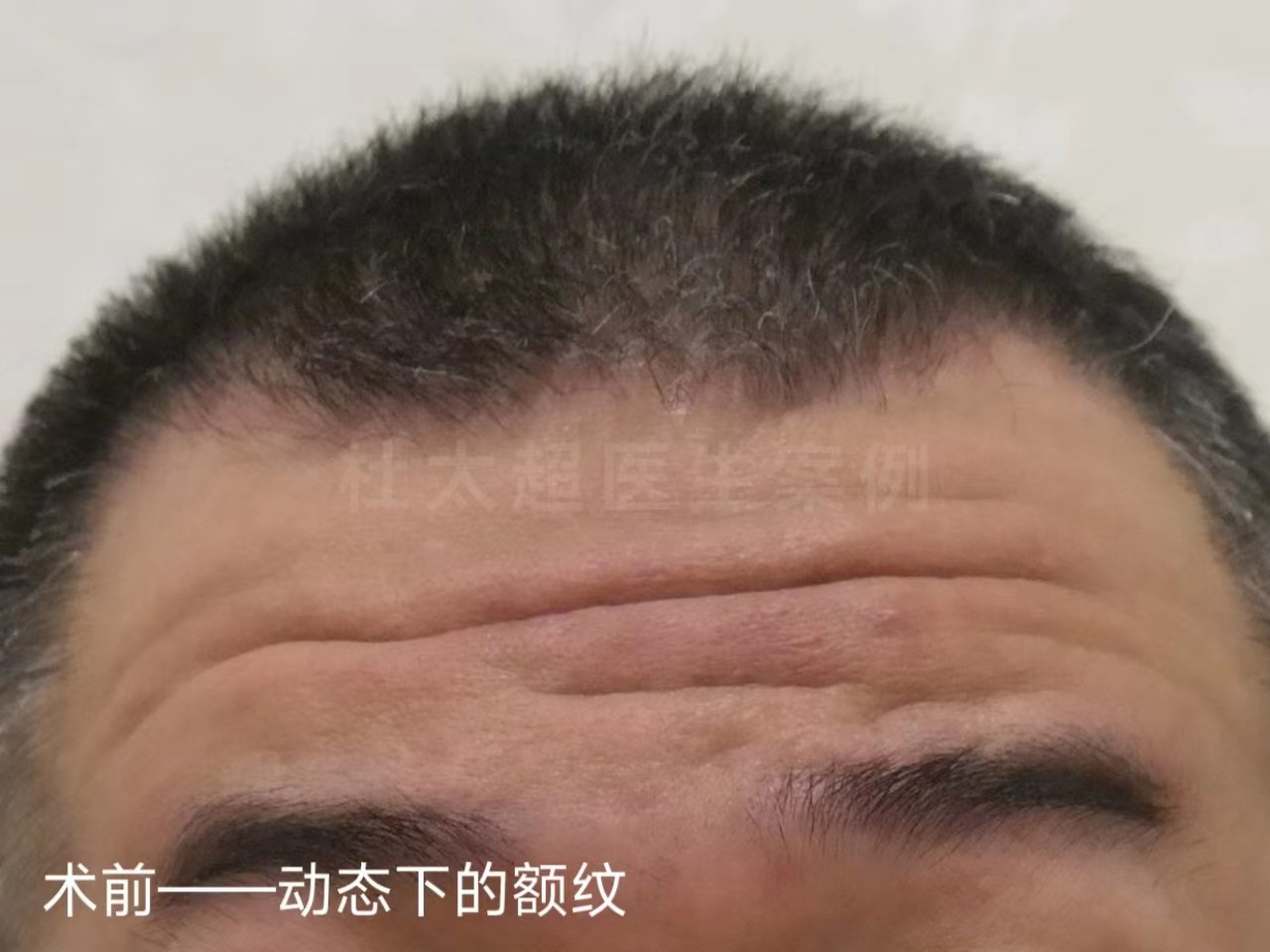 男士额纹深邃,不接受大切口除皱,这样做有效改善! 男士额纹深邃,不接受大切口除皱,这样做有效改善!