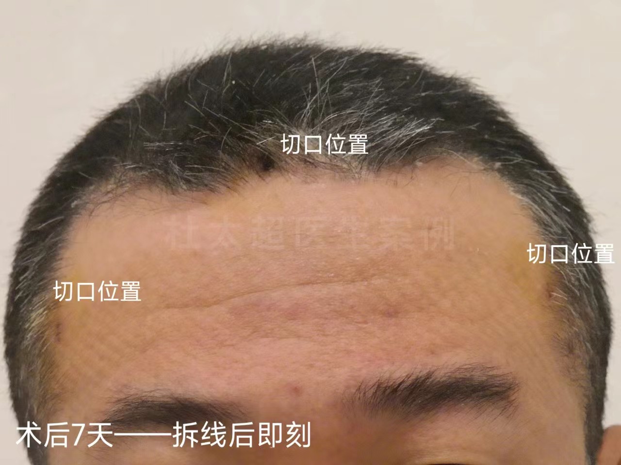 男士额纹深邃,不接受大切口除皱,这样做有效改善! 男士额纹深邃,不接受大切口除皱,这样做有效改善!