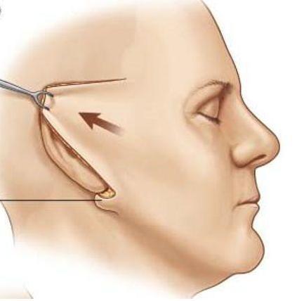 一次拉皮能维持10年?为什么我做的半年就垮了! 一次拉皮能维持10年?为什么我做的半年就垮了!