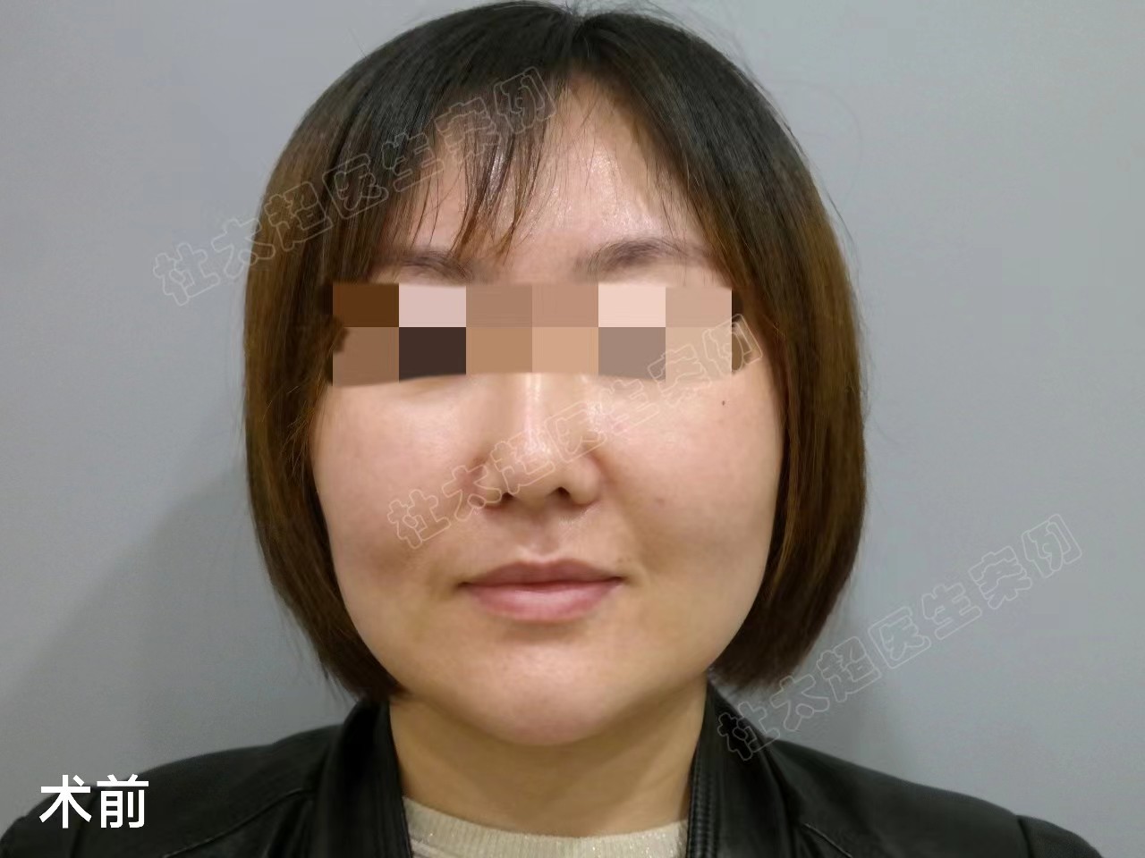 36岁接受不了血淋淋的大拉皮,选择小拉皮提升,记录手术全过程 36岁接受不了血淋淋的大拉皮,选择小拉皮提升,记录手术全过程