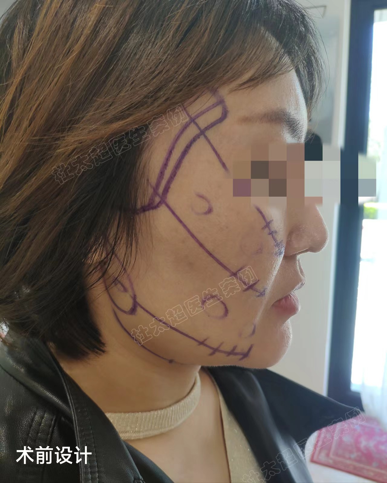 36岁接受不了血淋淋的大拉皮,选择小拉皮提升,记录手术全过程 36岁接受不了血淋淋的大拉皮,选择小拉皮提升,记录手术全过程