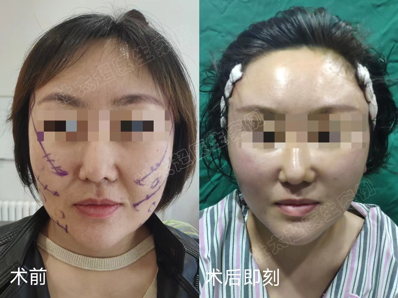 36岁接受不了血淋淋的大拉皮,选择小拉皮提升,记录手术全过程 36岁接受不了血淋淋的大拉皮,选择小拉皮提升,记录手术全过程