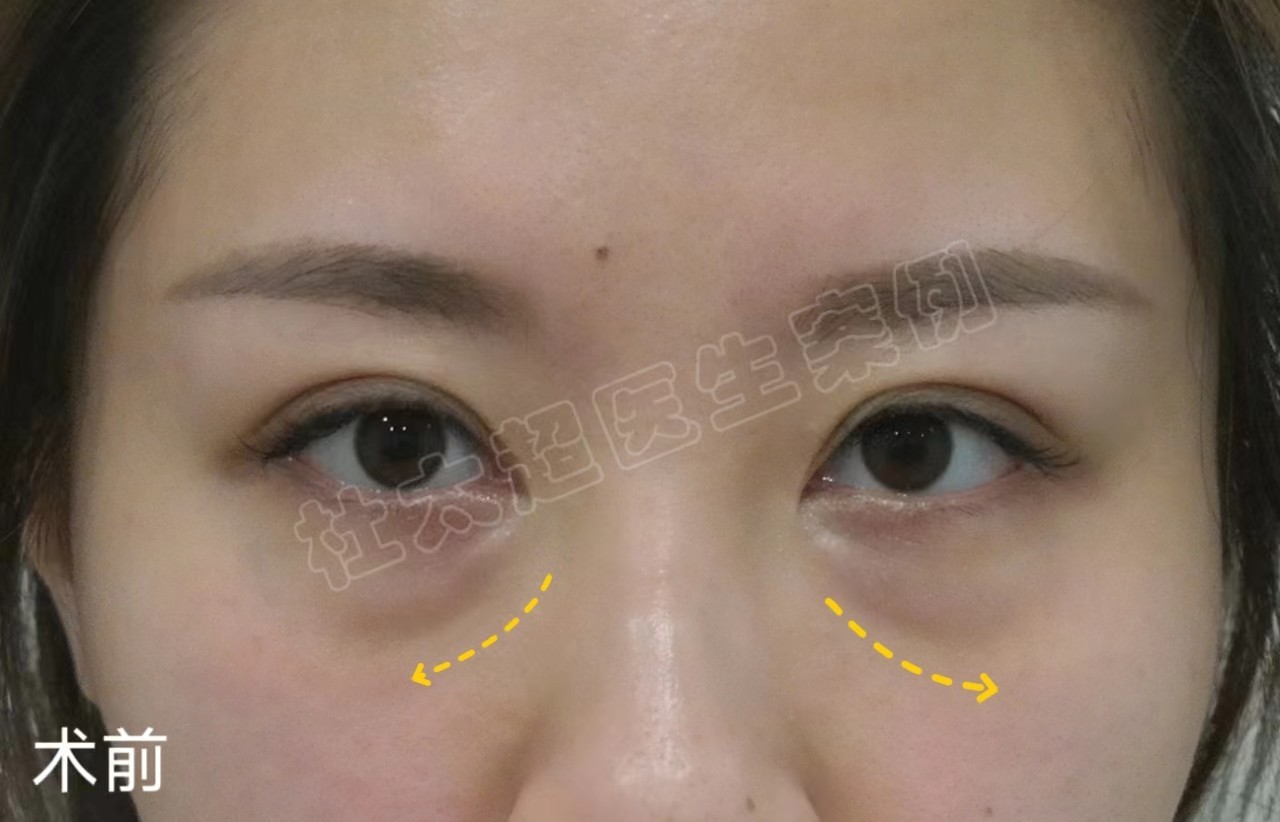 我做了微创去眼袋,只用了7天恢复,眼周重现年轻态 我做了微创去眼袋,只用了7天恢复,眼周重现年轻态