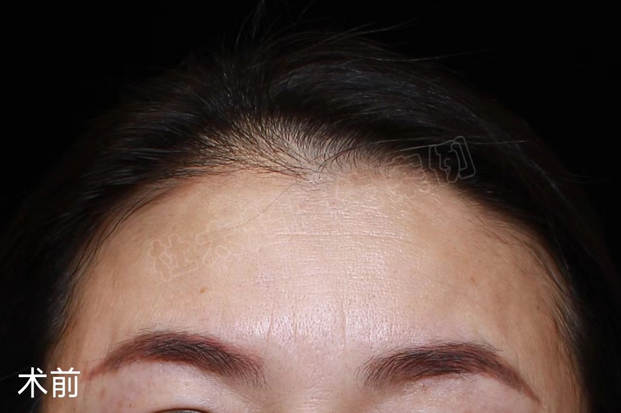 49岁女士做额部除皱,分享让“山川”变“平原”的秘密! 49岁女士做额部除皱,分享让“山川”变“平原”的秘密!