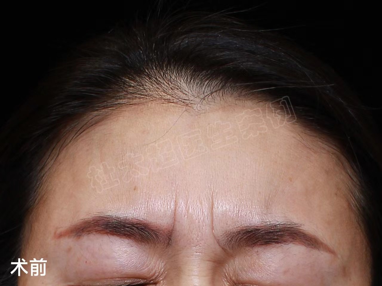 49岁女士做额部除皱,分享让“山川”变“平原”的秘密! 49岁女士做额部除皱,分享让“山川”变“平原”的秘密!