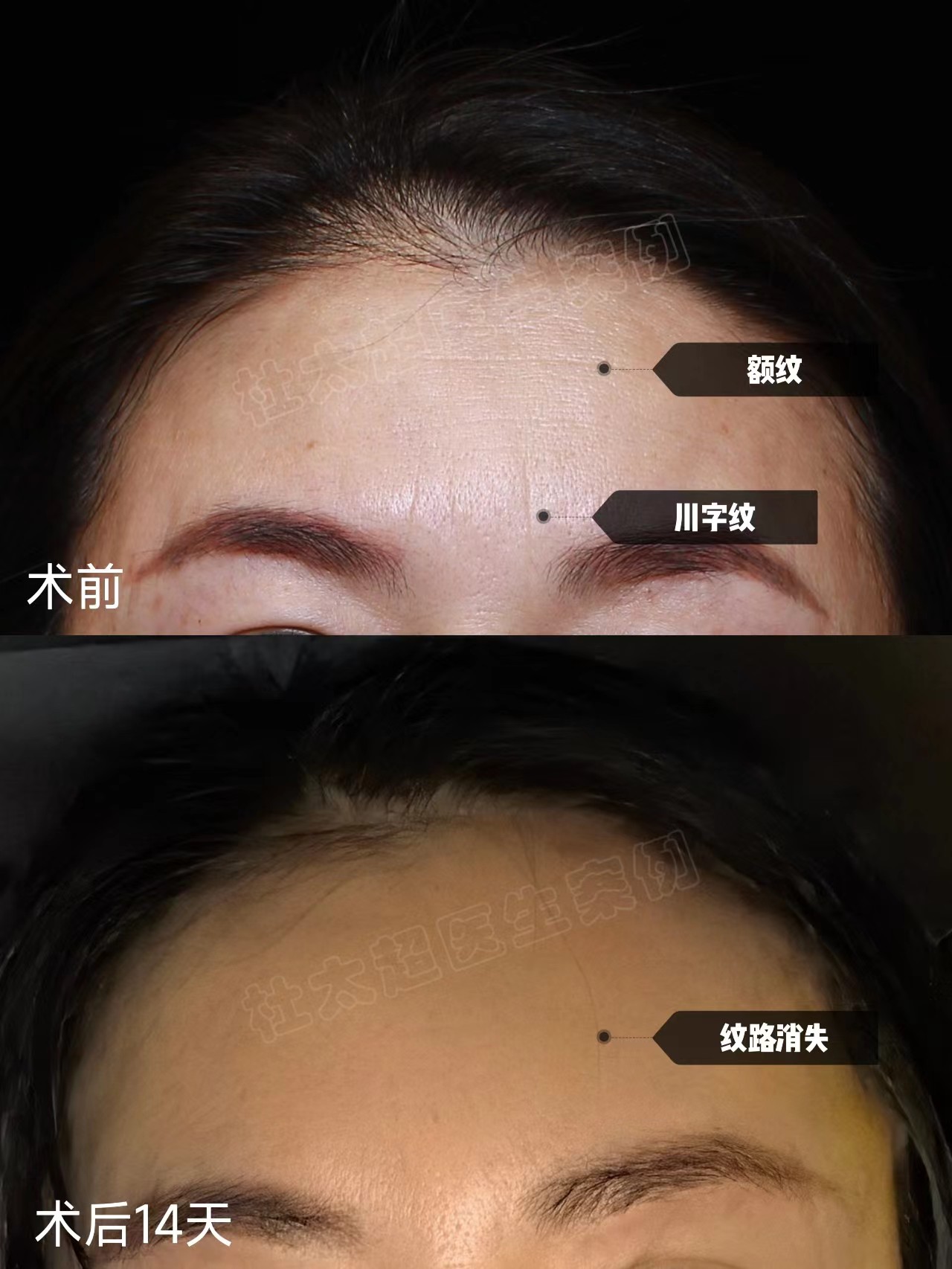 49岁女士做额部除皱,分享让“山川”变“平原”的秘密! 49岁女士做额部除皱,分享让“山川”变“平原”的秘密!