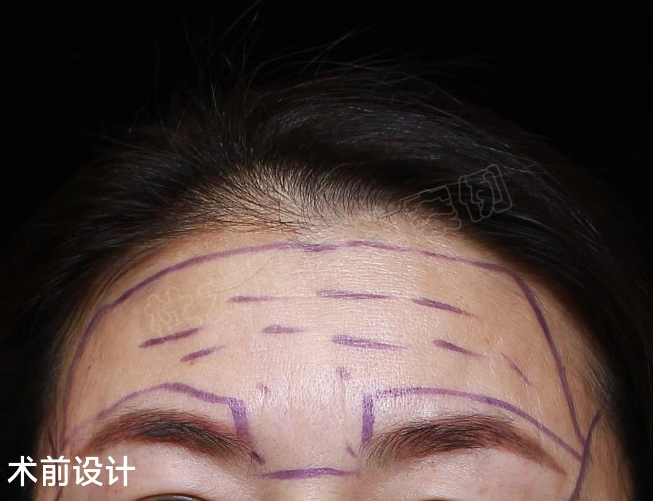 49岁女士做额部除皱,分享让“山川”变“平原”的秘密! 49岁女士做额部除皱,分享让“山川”变“平原”的秘密!