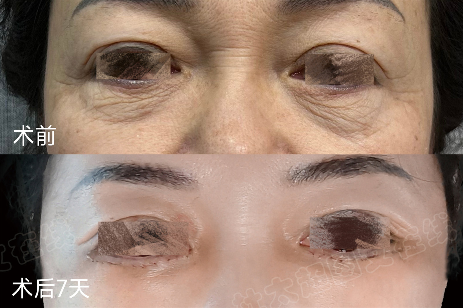 54岁求美者,为了变美奔赴北京做了拉皮提升,自己都被惊艳到 54岁求美者,为了变美奔赴北京做了拉皮提升,自己都被惊艳到