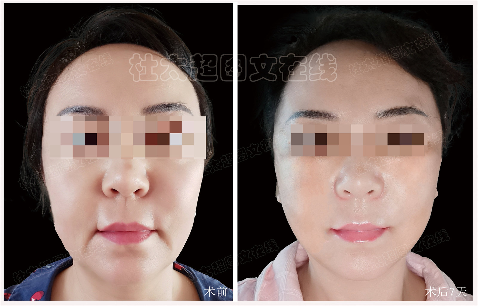 54岁求美者,为了变美奔赴北京做了拉皮提升,自己都被惊艳到 54岁求美者,为了变美奔赴北京做了拉皮提升,自己都被惊艳到