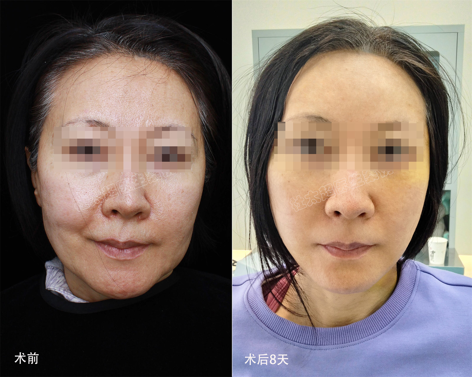 拉皮案例真实分享|术后效果肉眼可见 拉皮案例真实分享|术后效果肉眼可见