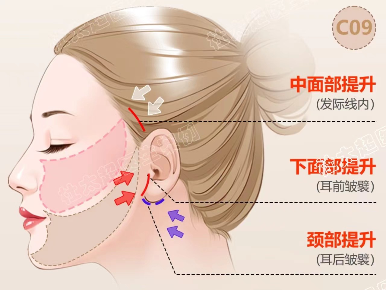 拉皮案例真实分享|术后效果肉眼可见 拉皮案例真实分享|术后效果肉眼可见