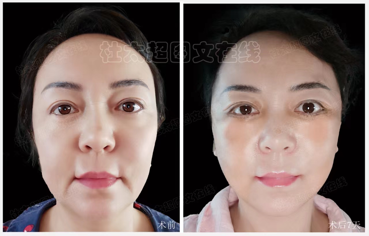 拉皮面部提升术后近期随访7天
