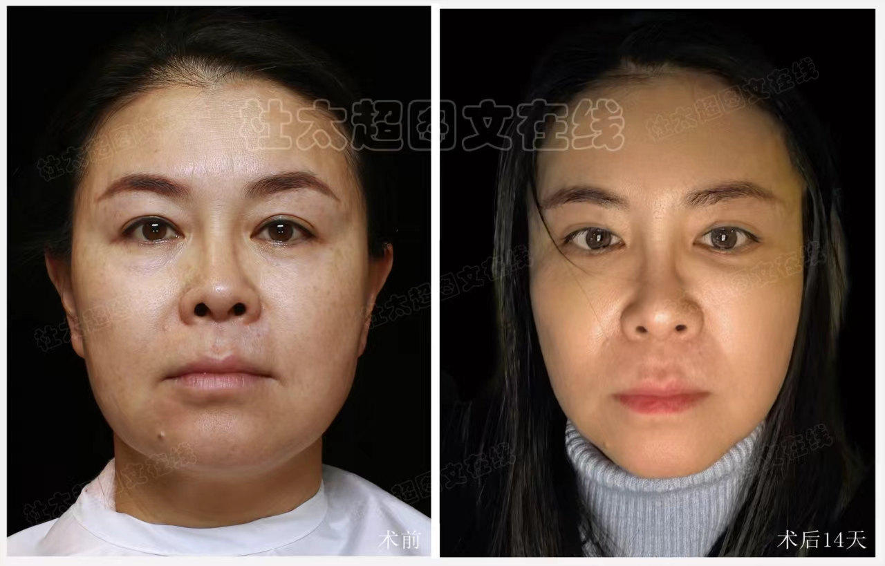 拉皮面部提升术后近期随访14天