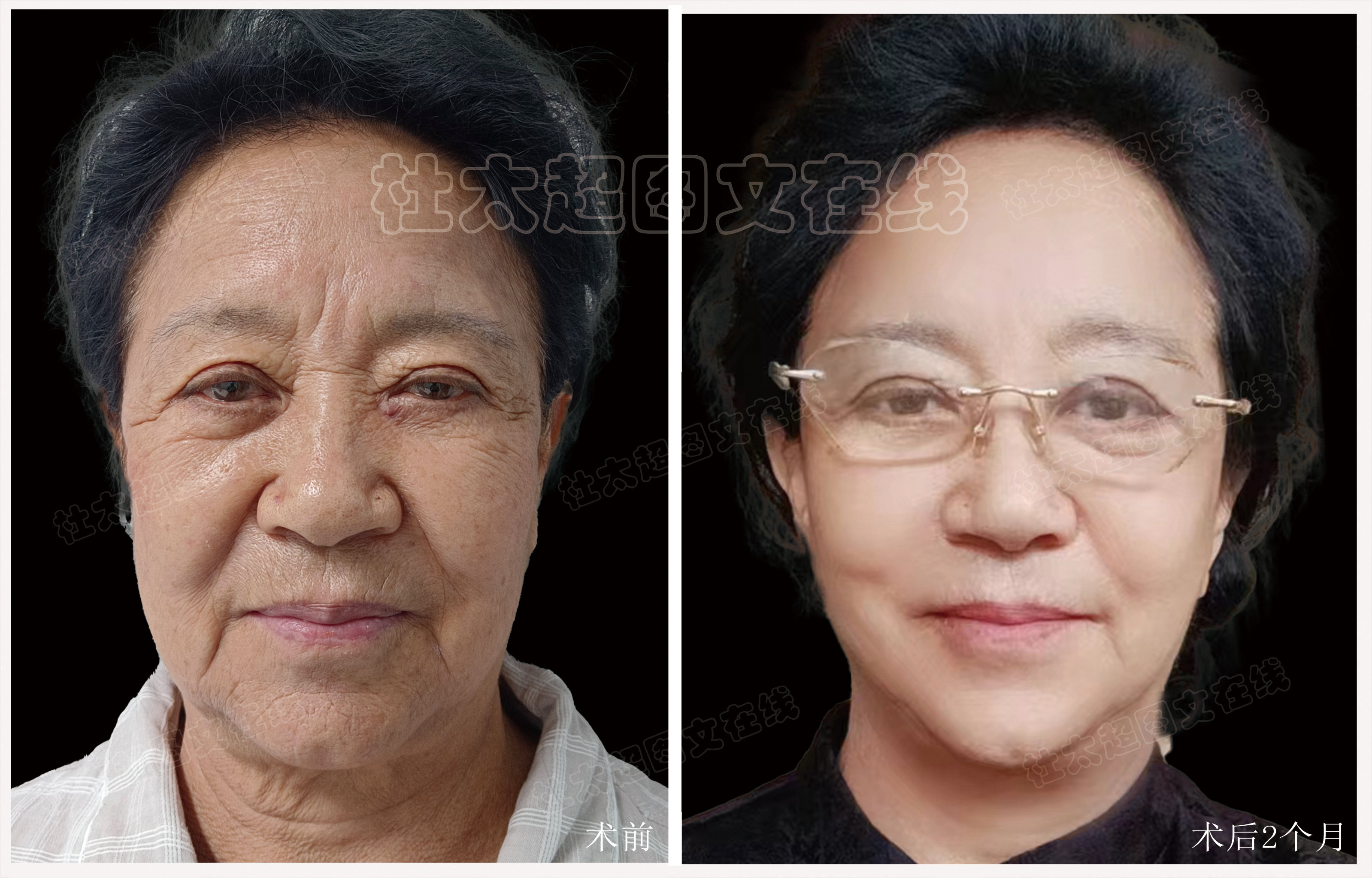 拉皮面部提升术后近期随访2个月
