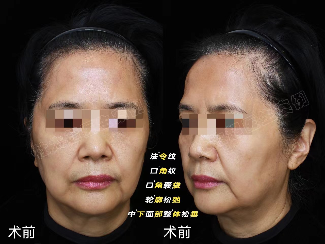 好直接！拉皮之后，松垂皱纹没有了，年轻真好！