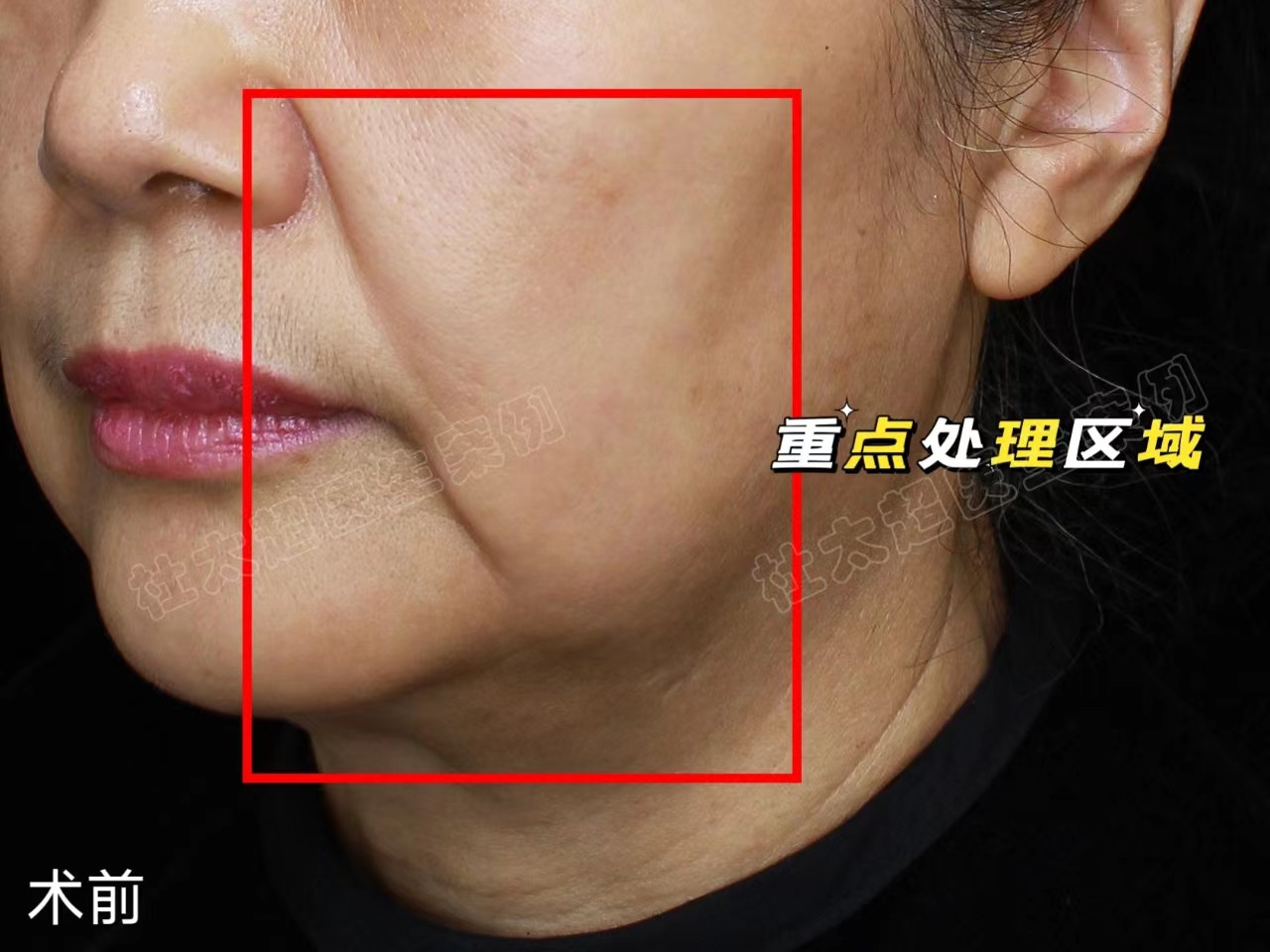 好直接！拉皮之后，松垂皱纹没有了，年轻真好！