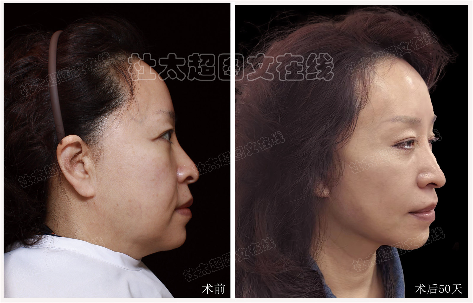 拉皮面部提升术后近期随访50天