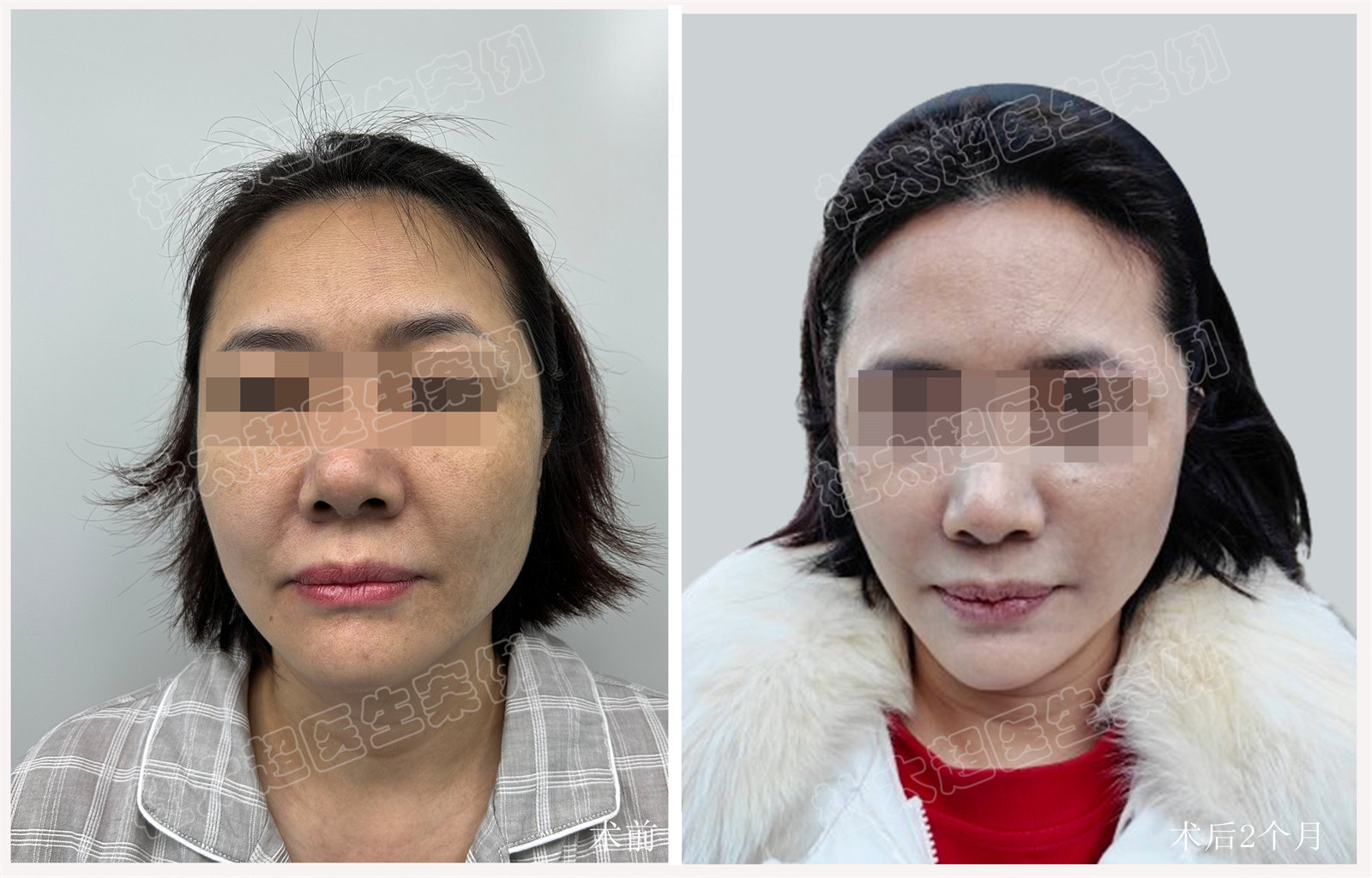 48岁拉皮效果最新反馈来了，自然、紧致非常满意！