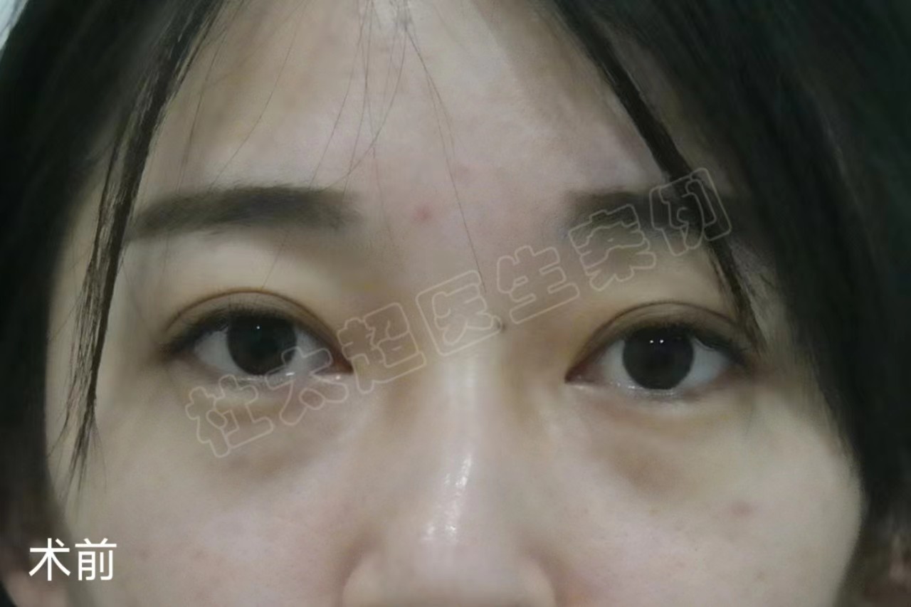 28岁做“眼袋手术”都说早，看完效果都说“好”