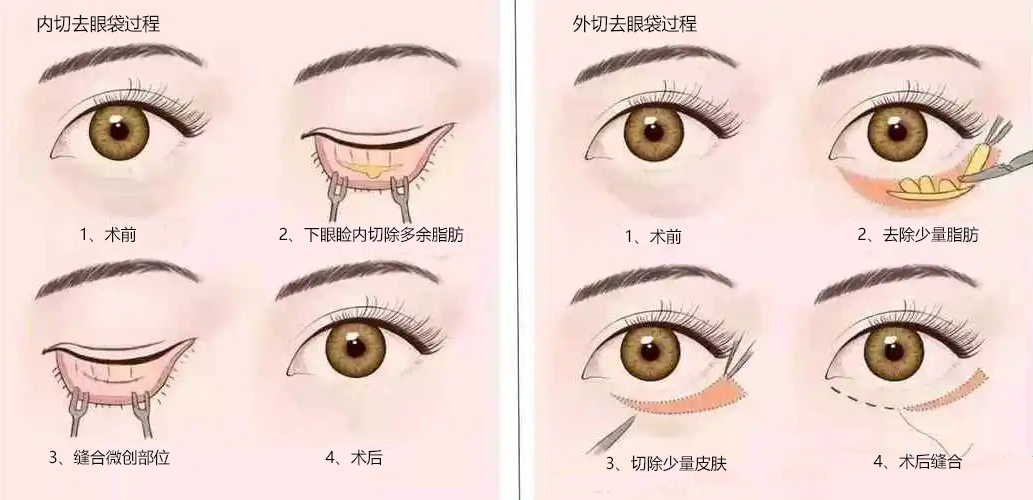 28岁做“眼袋手术”都说早，看完效果都说“好”