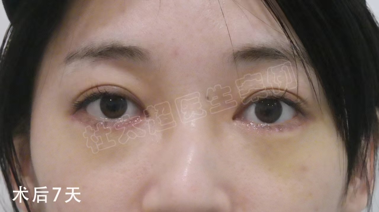 28岁做“眼袋手术”都说早，看完效果都说“好”