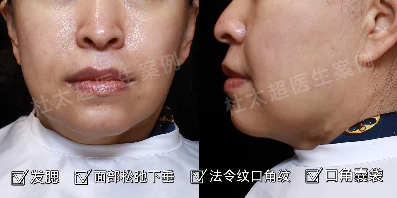 55岁追求年轻,做了拉皮手术,分享术后效果 55岁追求年轻,做了拉皮手术,分享术后效果