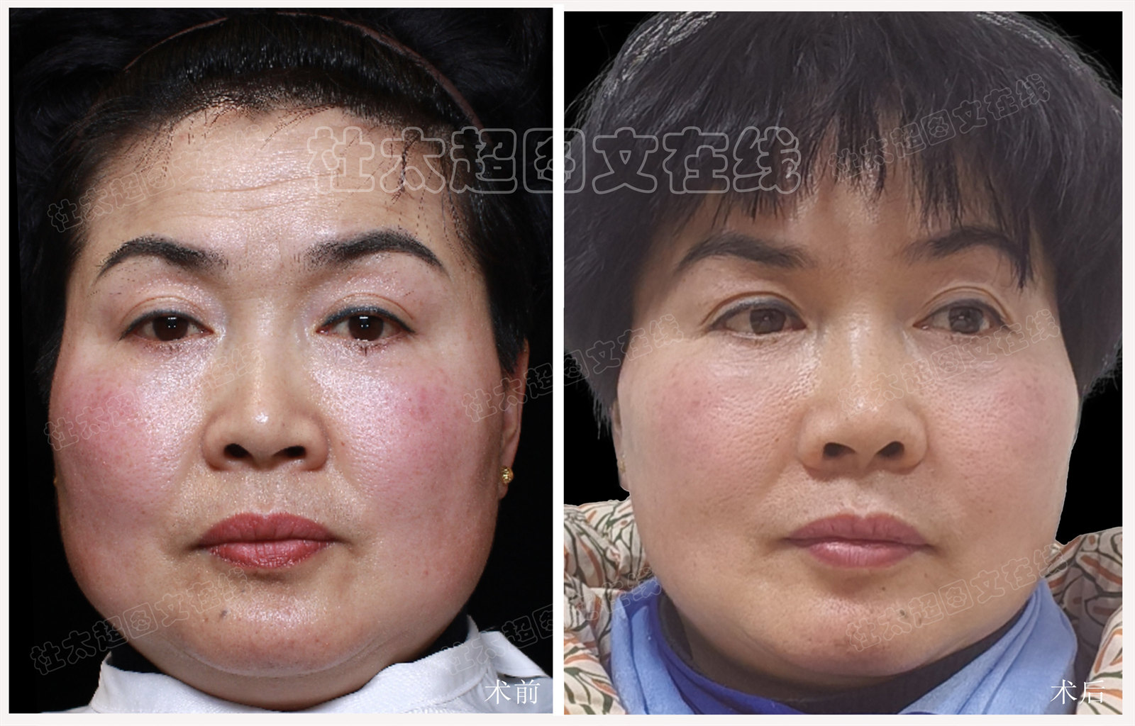 拉皮面部提升术后随访