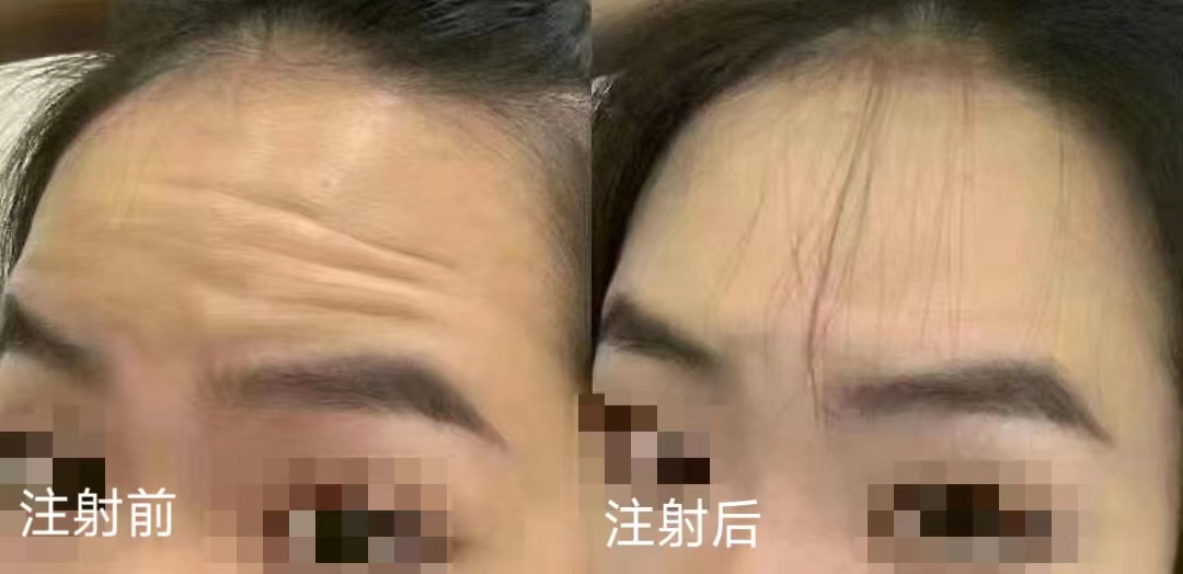 三种额纹去除方法公示,第3种适应症最广 三种额纹去除方法公示,第3种适应症最广